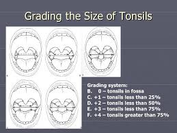 Pin By Val Logz On Surgery Tonsils Adenoids Disorders