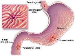 stomach ulcer surgery
