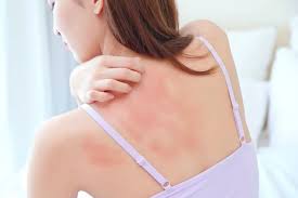 simple home remes to treat heat rashes