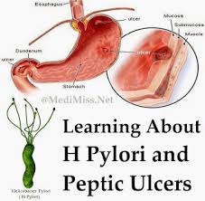 Peptic ulcer etiology map   NURSING GI   Pinterest   Peptic ulcer     SlideShare
