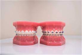 Know how long it could take. How Long Does It Take To Get Braces On Orthodontic Treatment Near Me