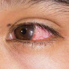 eye infection recognizing symptoms a