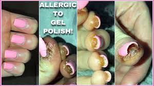 methacrylate gel polish allergy
