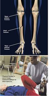 tibial fractures orthopedic surgeon