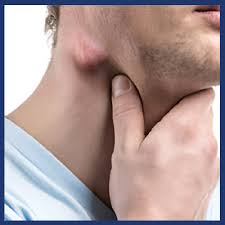 homeopathic treatment for swollen lymph