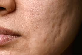 acne scar treatment removal singapore