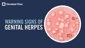 5 warning signs of herpes you