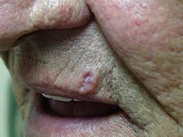 basal cell carcinoma lip cancer