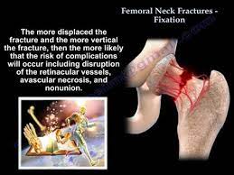 fem neck fractures fixation