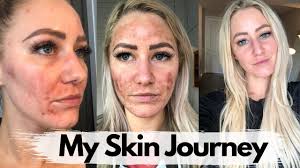 makeup for sensitive acne e skin