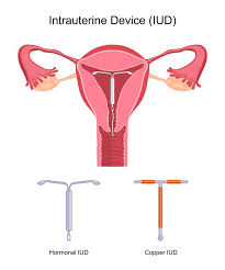 intra uterine device iud singapore