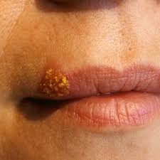 cold sores on lips pictures causes