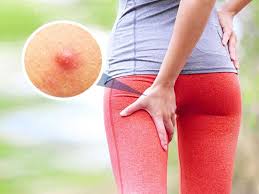 boils on hips symptoms causes and