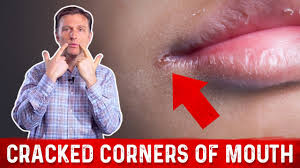 what causes ed corners of mouth
