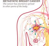 Metastatic Breast Cancer: What Is It, Symptoms, and More