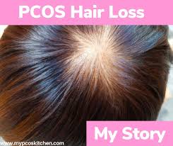 pcos hair loss my story and what i ve