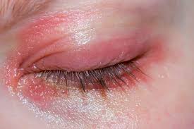 blepharitis eyelid inflammation