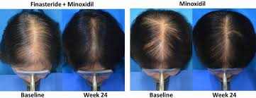 topical finasteride guide uses