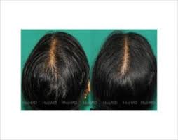 for hair to grow back after hair loss