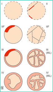 Simple And Complex Renal Cysts In Adults Classification