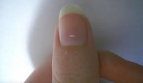 the white marks on your nails are not
