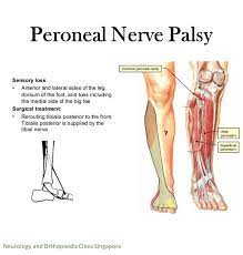 peroneal nerve palsy solution