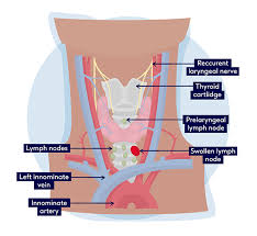sore throat tonsillitis symptoms