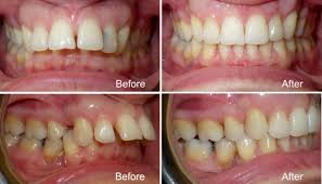 Orthodontic treatment options for overbite correction have not been very appealing. What Is Overjet Symptoms Diagnosis And Orthodontic Treatment