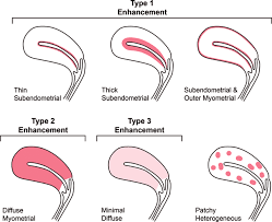 uterine enhancement