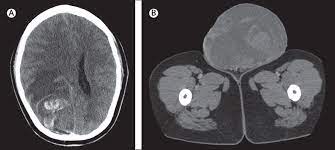 testicular cancer with neurological