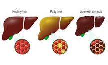 Which alcohol is hardest on liver?