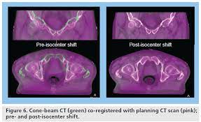 cone beam ct for bladder radiotherapy