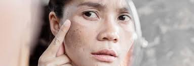 The term uneven skin tone can mean several different things ranging from texture to hyperpigmentation concerns. Treating Uneven Skin Tone And Pigmentation The Skin Care Clinic