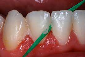 Proses cuci gigi yang dilakukan di klinik pergigian swasta. Doktor Gigi Ini Kongsikan Kebaikan Scaling Gigi Yang Perlu Dibuat 6 Bulan Sekali