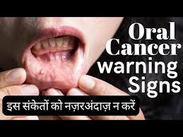 mouth cancer symptoms in hindi early