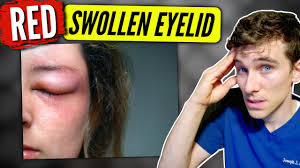 swollen eyelid causes solutions