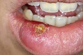 Cold Sore(Herpes Labialis, Fever Blister, Oral Herpes, Herpes Simplex)