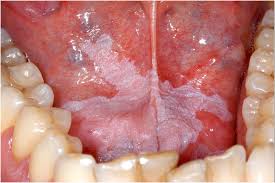 leukoplakia of the floor of the mouth
