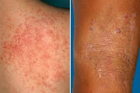 heat rash vs eczema what s the