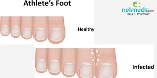 foot soaks to prevent fungal infection