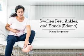 swollen feet ankles and hands edema