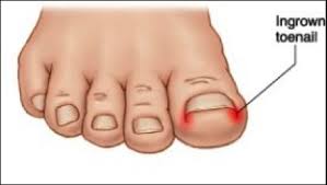 ingrown toenails what how why
