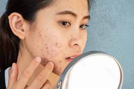 acne treatment in singapore