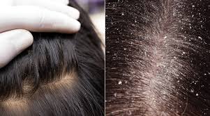 head lice vs dandruff identifying