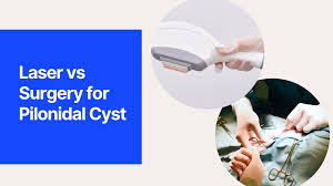 the truth about pilonidal cysts can