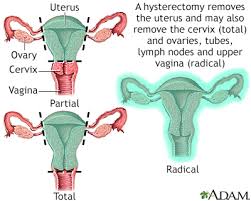 hysterectomy abdominal discharge