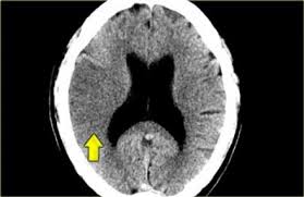 The Radiology Assistant Brain Ischemia Imaging In Acute