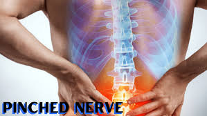 occupational therapy for pinched nerve