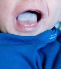 See full list on wikihow.com Is That Really Thrush On Your Baby S Tongue Milk Matters Infant Feeding Solutions