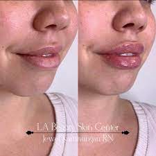 lip augmentation la beauty skin